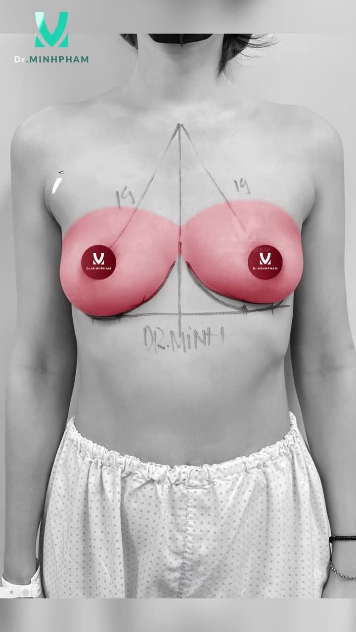KẾT QUẢ SAU NÂNG CẤP V1 ERGONOMIX 2 TẠI DR. MINH PHẠM