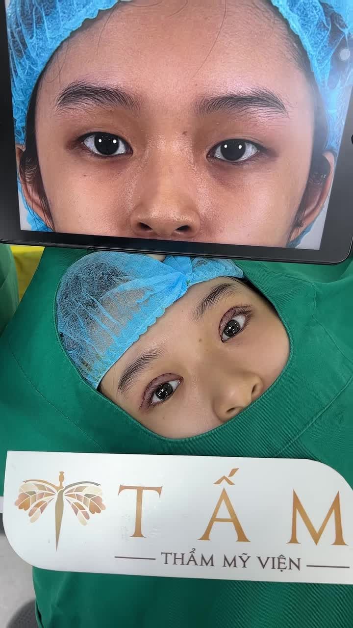 Cùng theo dõi hình ảnh trước và sau khi Cắt mí của bạn khách hàng tại Tấm.