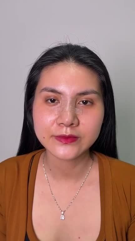 HOT: Nữ khách hàng Gen Z sở hữu dáng mũi CAO SANG, CUỐN HÚT tự tin đón hè sau Nâng mũi S Line 3D tại JW