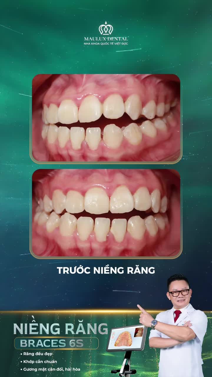 Khớp cắn hở thay đổi như thế nào sau niềng răng?