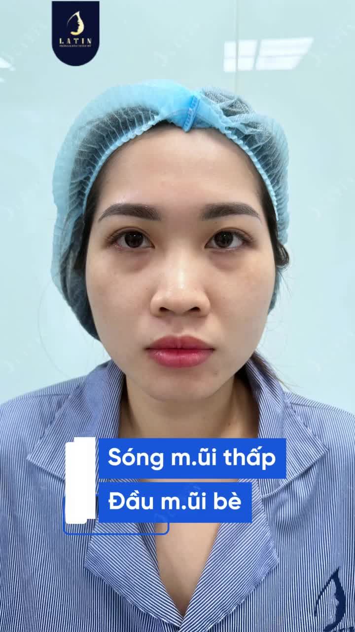 MŨI ĐẸP TỰ NHIÊN KHÔNG TỰ NHIÊN MÀ CÓ