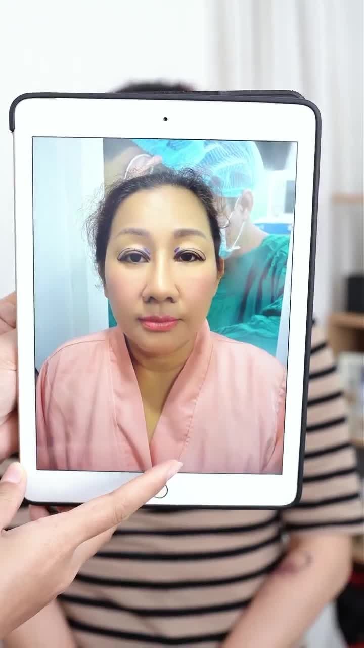 10 NGÀY NÂNG MŨI SỬA LẠI + CẮT MÍ MINI DEEP DR. HOẠT