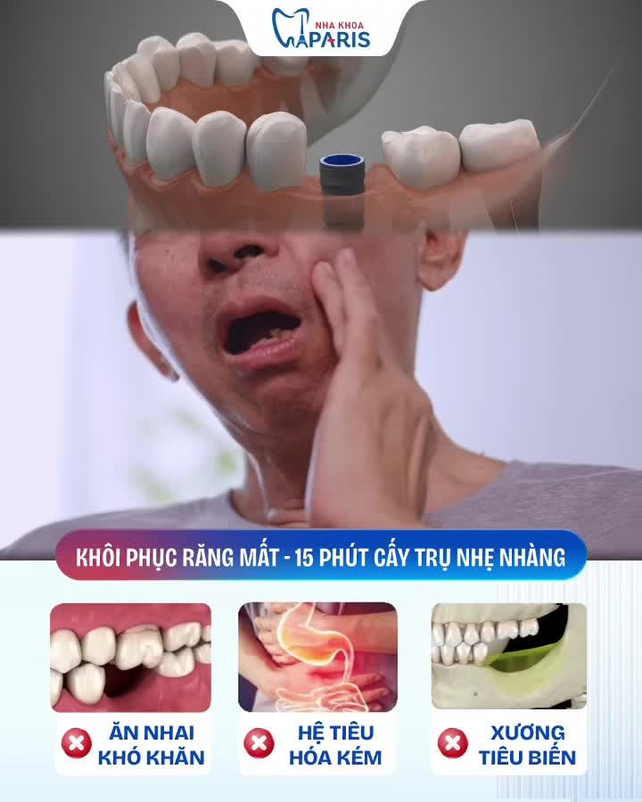 CHẤM DỨT NỖI LO MẤT RĂNG: TRỒNG IMPLANT 4S — ĂN NHAI NGON LÀNH NGAY LẬP TỨC!