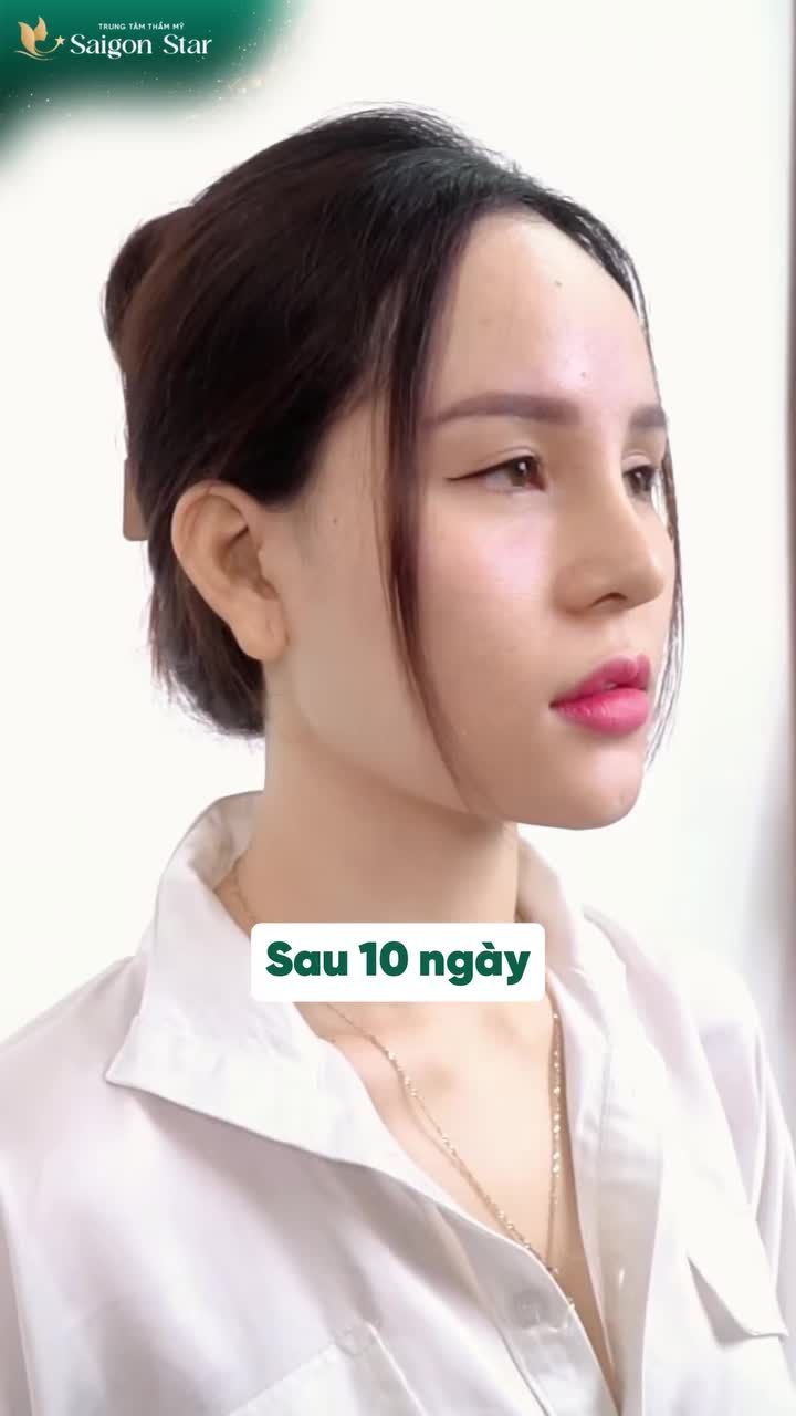 SỬA LẠI MŨI HỎNG SAU 1 THÁNG SẼ RA SAO