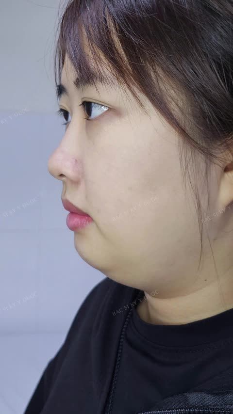 Hình ảnh thực tế kết quả combo Hút Mỡ Nọng Cằm + Độn Cằm Golden V