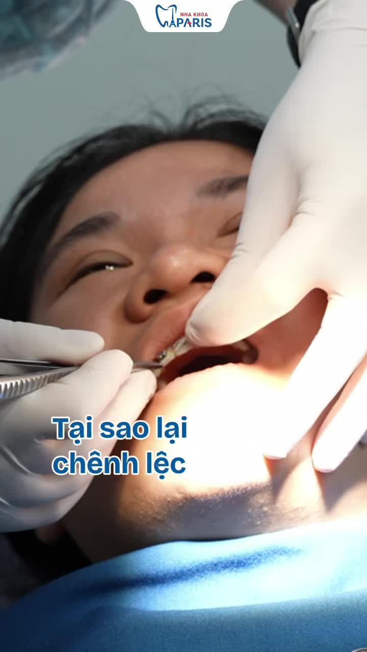 SO SÁNH MẮC CÀI THƯỜNG VÀ MẮC CÀI TỰ BUỘC