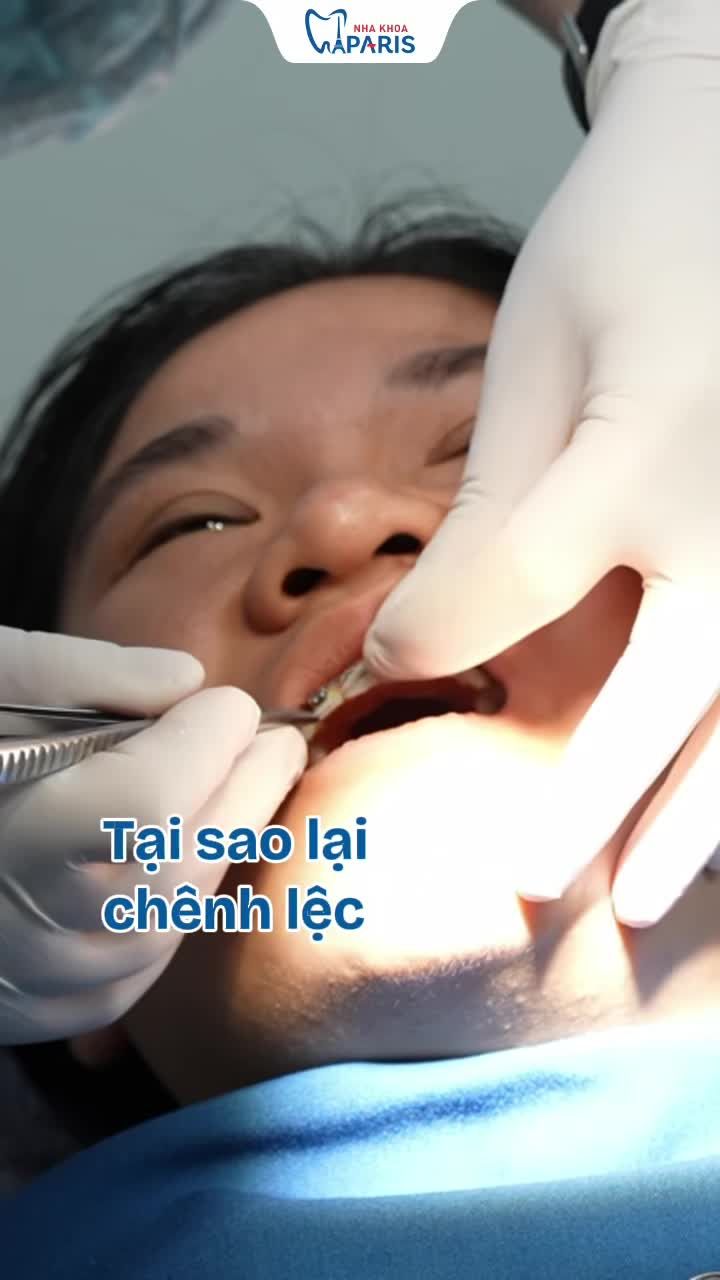 SO SÁNH MẮC CÀI THƯỜNG VÀ MẮC CÀI TỰ BUỘC