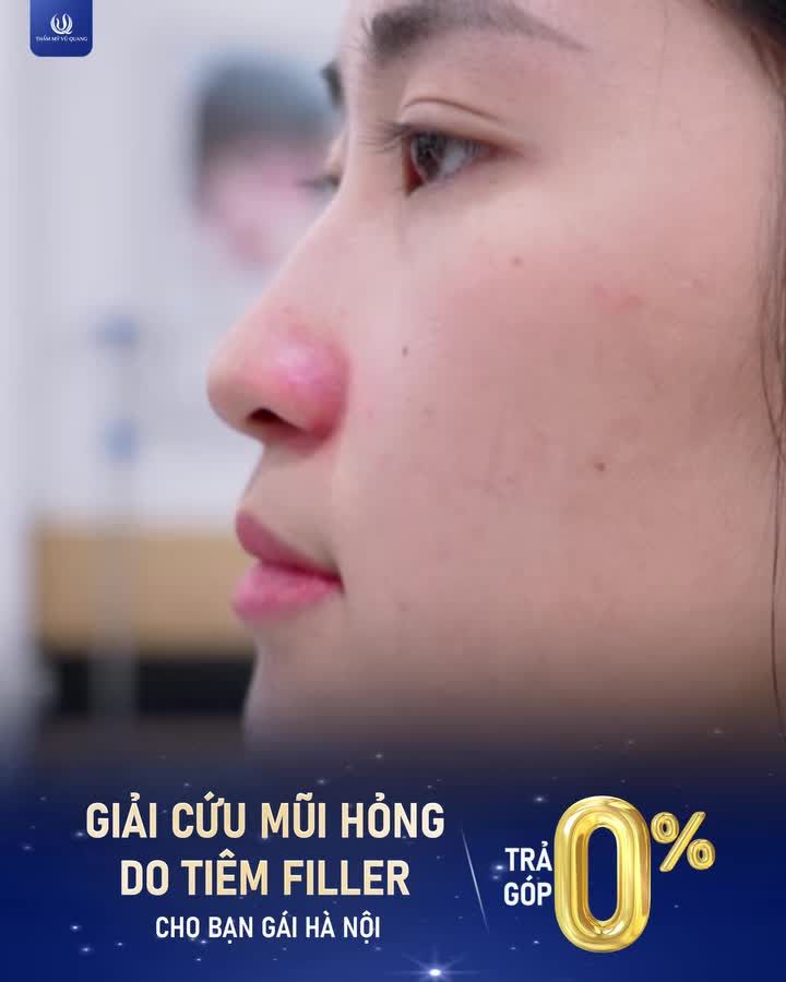 Từng khép mình và đầy tự ti vì biến chứng tràn filler, bạn khách nhà Thẩm mỹ Vũ Quang đã có quyết định đúng đắn nhất: Nhờ bác sĩ Vũ Quang nâng cấp diện mạo, tìm lại chính mình.