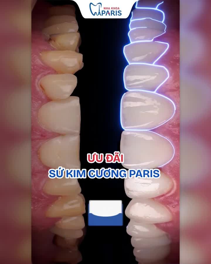 RĂNG SỨ GIẢM ĐẬM SÂU NHẤT HÈ 2026