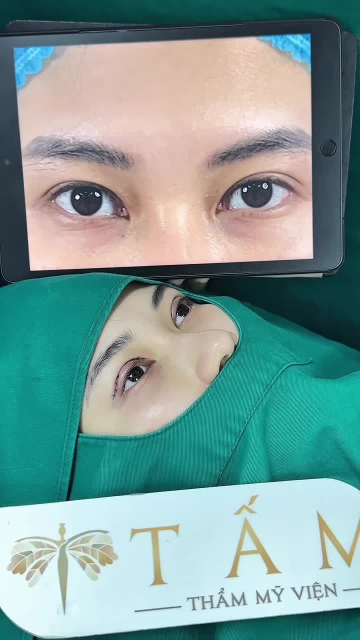 Khắc phục khuyết điểm nếp mí trên và cấy mỡ mắt là hành trình đầy trọn vẹn của chị D tại Thẩm mỹ viện Tấm