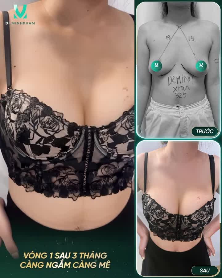 Sau 3 tháng form ngực đã dần ổn định với độ mềm mại tự nhiên, cân đối và hài hòa với vóc dáng khách hàng.