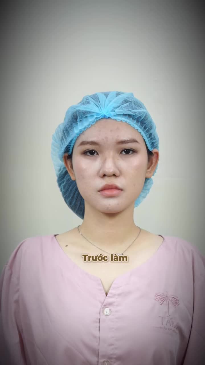 Chị khách lướt TikTok quá 180 phút và cái kết... đi nâng mũi luôn! Nghe vô lý nhưng lại cực kỳ thuyết phục khi nhìn thấy dáng mũi mới này tại Tấm, với: