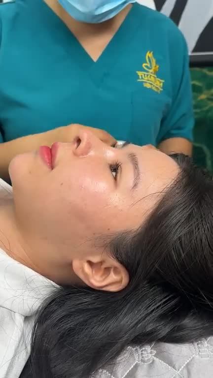 MŨI CẤU TRÚC SURGIFORM SAU 20 NGÀY – ĐẸP MỌI GÓC NHÌN