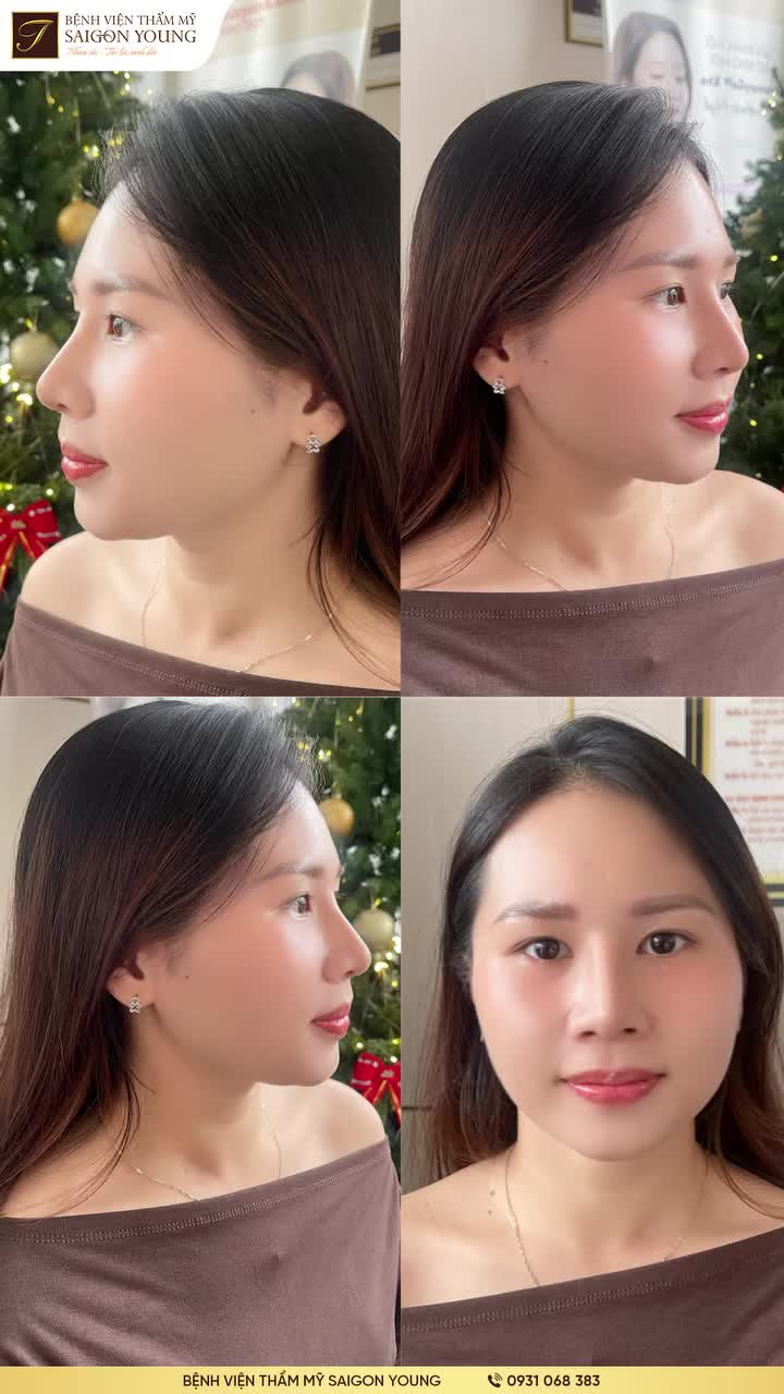 TẠO HÌNH DÁNG MŨI TẠI SAIGON YOUNG