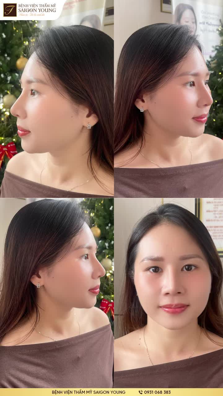 TẠO HÌNH DÁNG MŨI TẠI SAIGON YOUNG