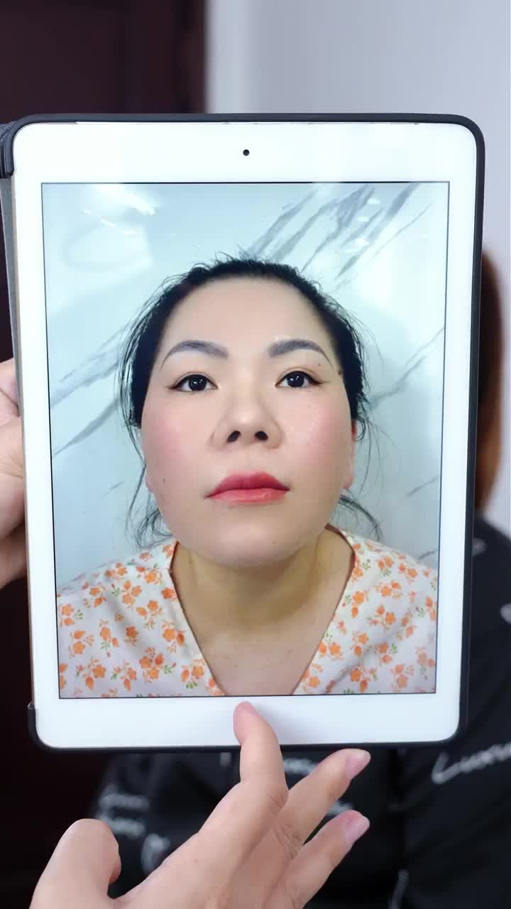 KẾT QUẢ SAU 10 NGÀY NÂNG MŨI CẤU TRÚC - SỬA LẠI MŨI HỎNG
