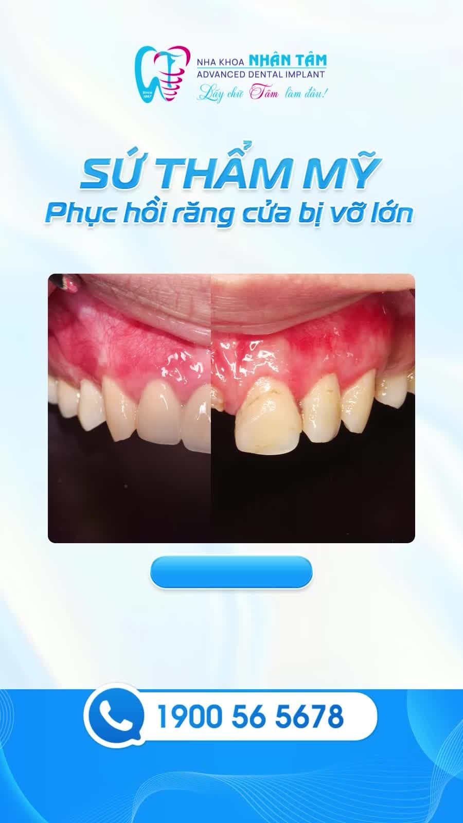 SỨ THẨM MỸ - PHỤC HỒI RĂNG CỬA BỊ VỠ LỚN