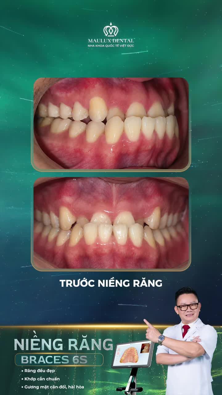 Giải pháp cho khớp cắn ngược