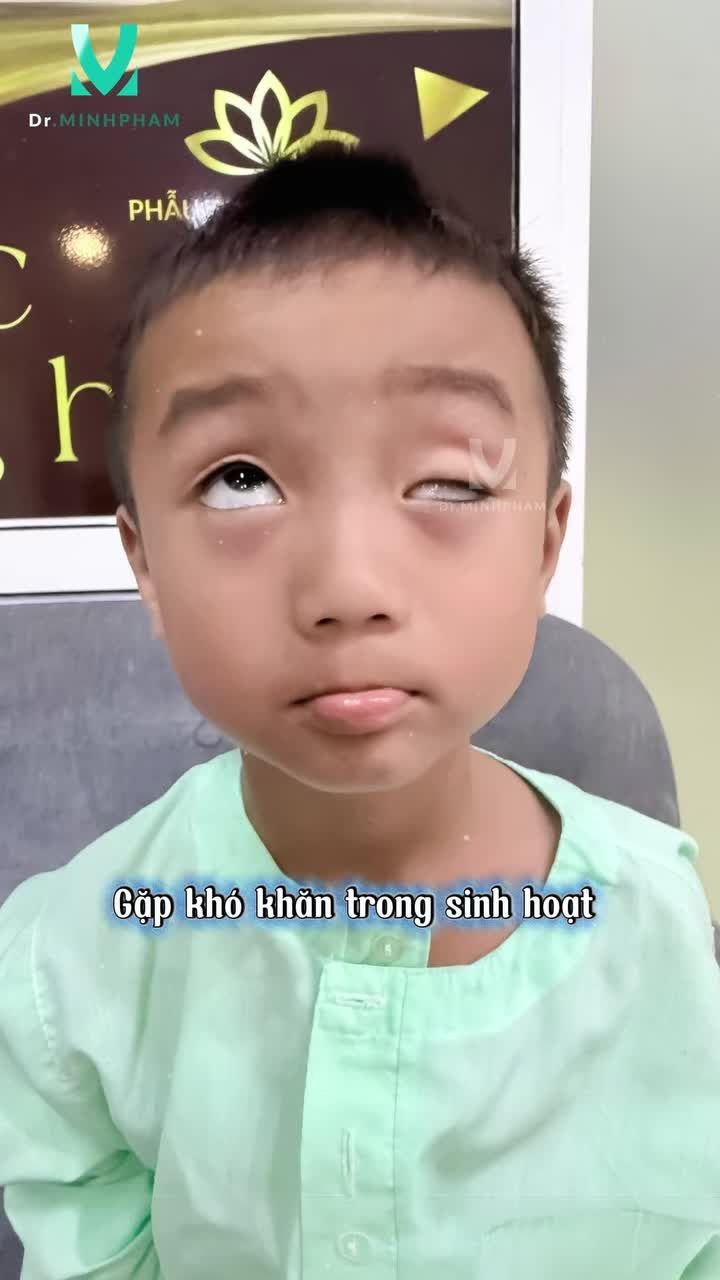 Từng bị sụp mí bẩm sinh khiến ánh nhìn không trọn vẹn