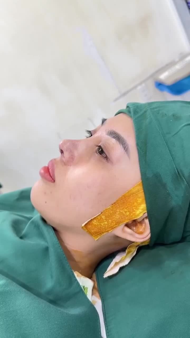 KHOE GÓC NGHIÊN THANH THOÁT SAU 60 PHÚT NÂNG MŨI CẤU TRÚC DR. HOẠT KH: YẾN LINH (CÀ MAU)