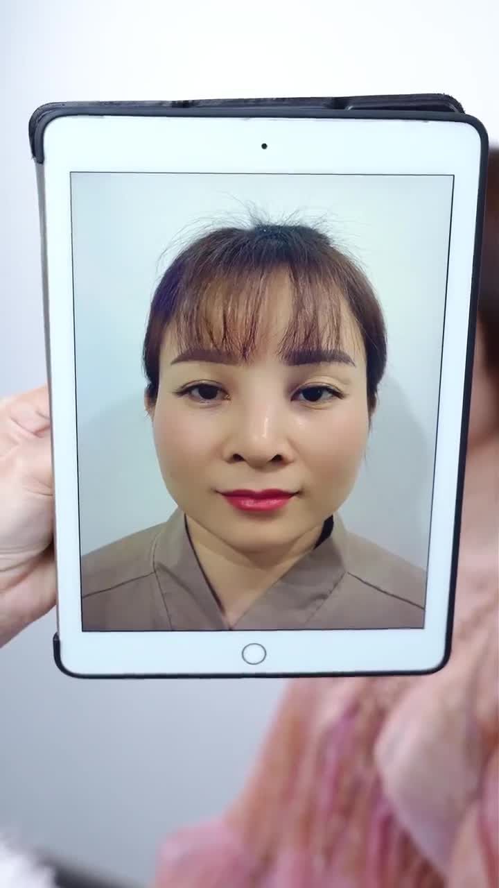 SAU 13 NGÀY RÚT SỤN + CẤY TRUNG BÌ KỊP THỜI GIẢI CỨU MŨI VIÊM NẶNG!!!