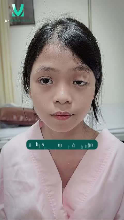 Ánh mắt là điều đầu tiên giúp trẻ tự tin khám phá thế giới. Với bé Bảo Linh, tình trạng sụp mi không chỉ ảnh hưởng đến thẩm mỹ mà còn phần nào cản trở tầm nhìn trong sinh hoạt hằng ngày.
