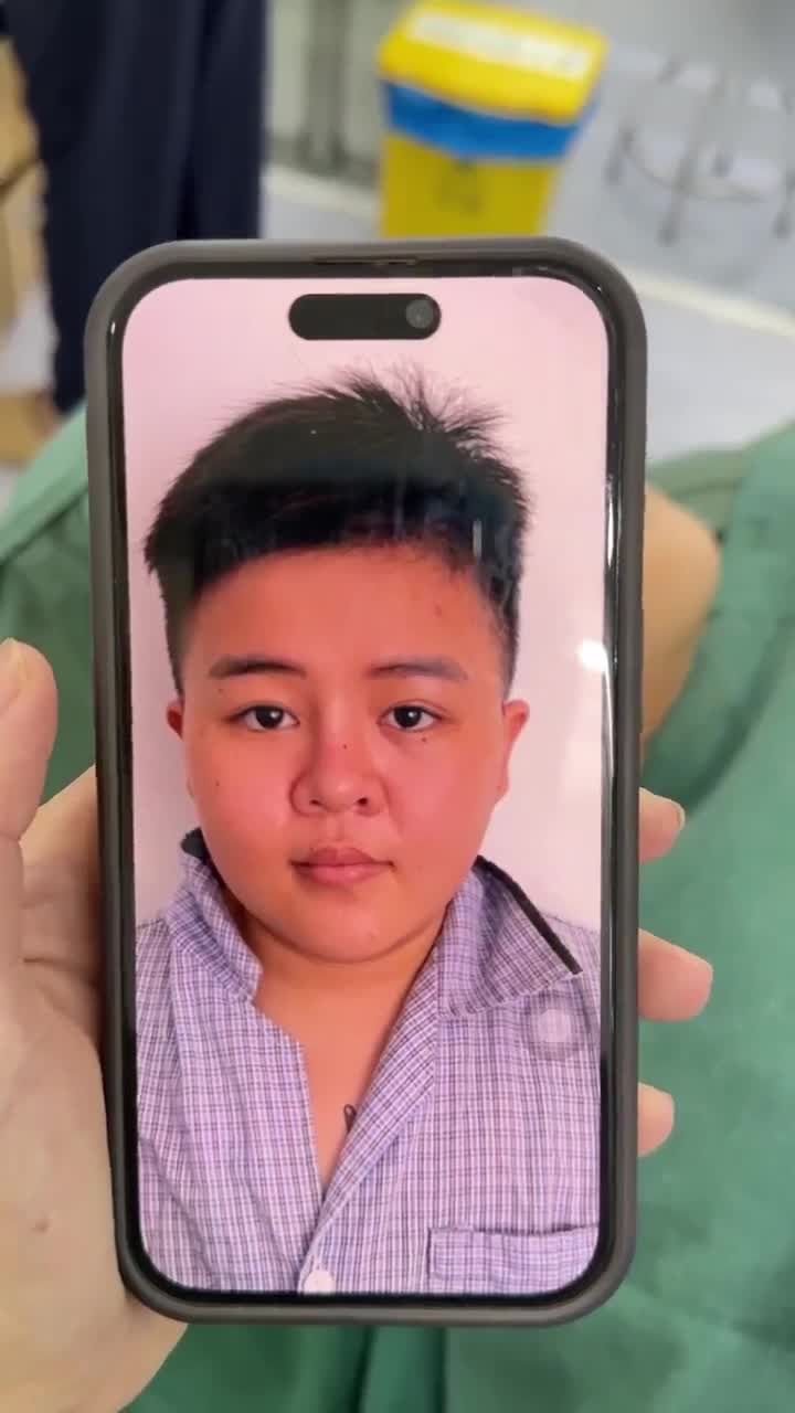 KẾT QUẢ SAU 60 PHÚT NÂNG MŨI CẤU TRÚC - SỬA LẠI MŨI HỎNG CHO BẠN KHÁCH HÀNG GEN Z