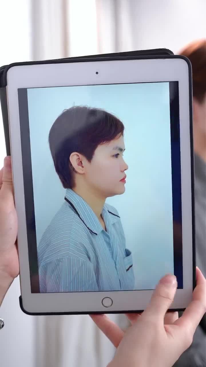 10 NGÀY SAU KHI NÂNG MŨI SẼ RA SAO???