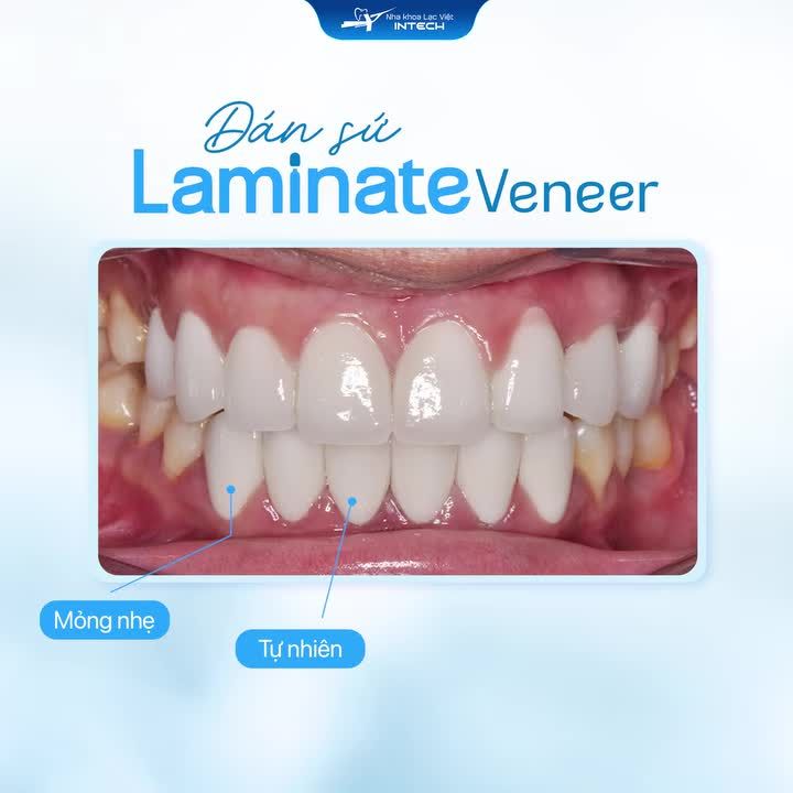 DÁN SỨ VENEER - “CỨU TINH” CHO NỤ CƯỜI CHƯA HOÀN HẢO!