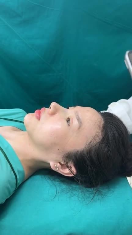 NÂNG MŨI CẤU TRÚC RÚT CHỈ VỪA HOÀN THÀNH - DÁNG MŨI ĐẸP XUẤT SẮC!!