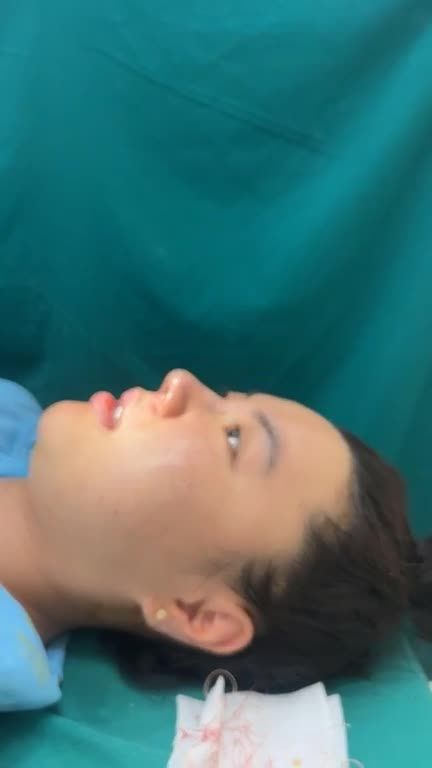 Mũi cấu trúc rút chỉ