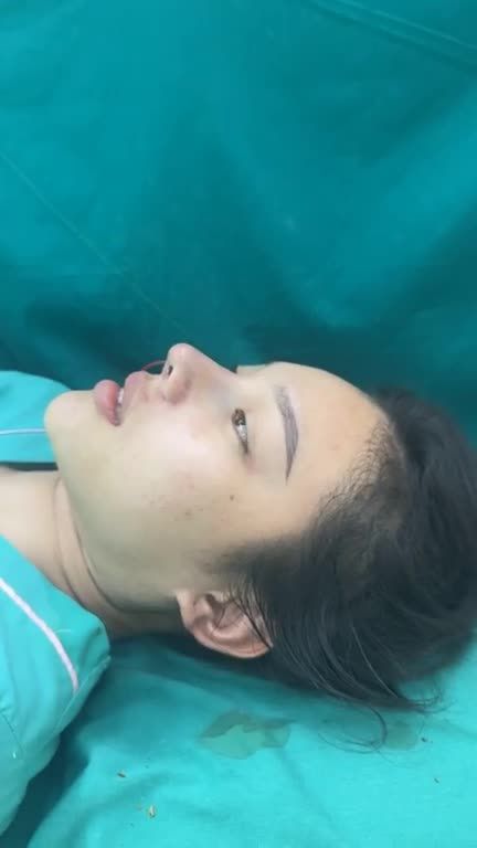 Mũi tái cấu trúc vừa hoàn thành