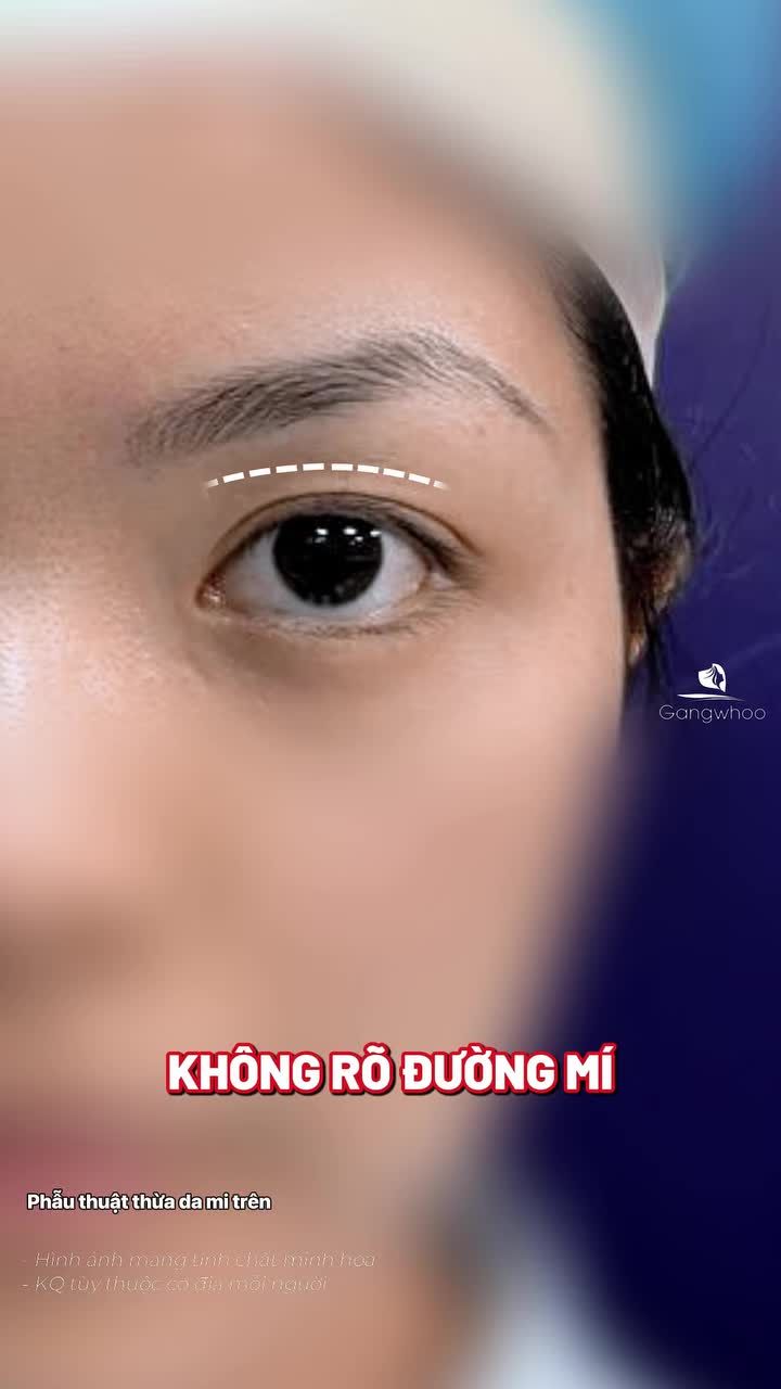 Mắt nhiều da chùng, không rõ đường mí,... chỉ khoảng 45 phút thực hiện tại Gangwhoo các khuyết điểm đều được khắc phục. Quá trình nhanh chóng, an toàn, không đau và chuẩn y khoa.