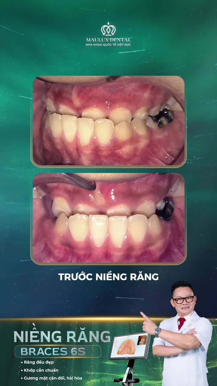 Khớp cắn ngược, niềng răng càng sớm, lớn càng tự tin