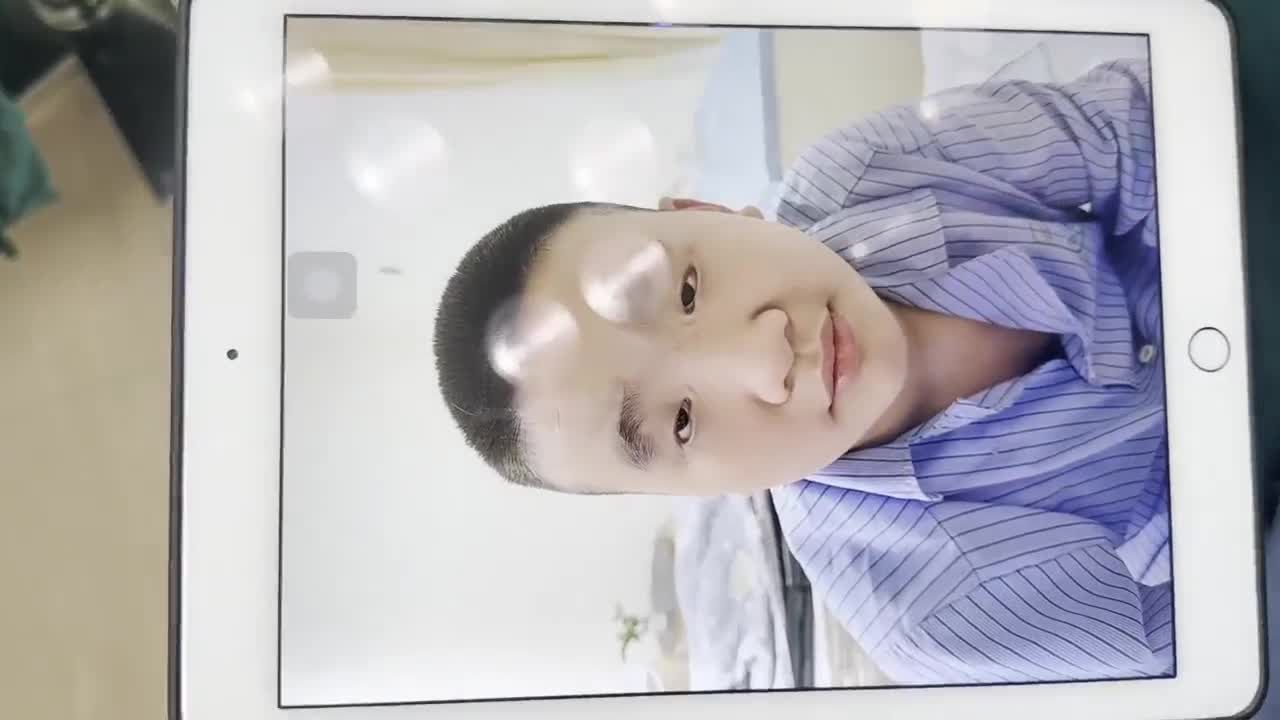Kết quả sau treo mi bằng chuyển vạt cơ trán