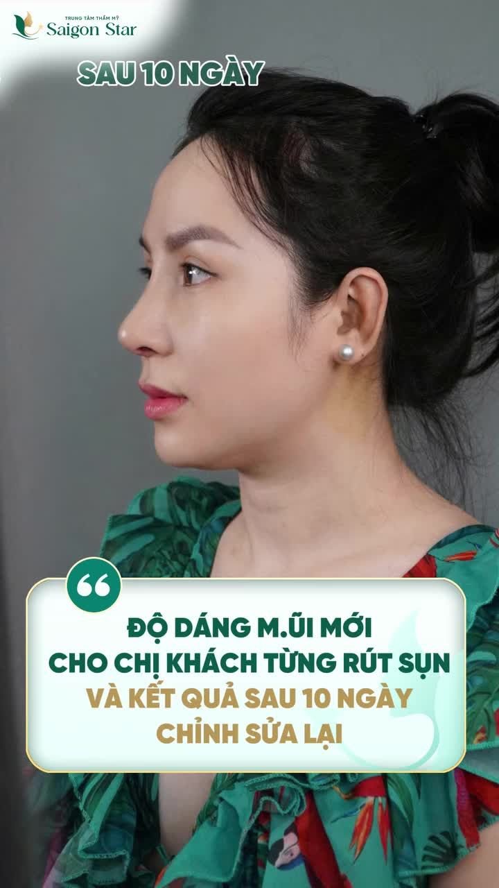 TỪNG RÚT SỤN VÌ BIẾN CHỨNG  CHỈ SAU 10 NGÀY ĐẾN VỚI SAIGON STAR CHỊ KHƯƠNG LY ĐÃ TÌM LẠI SỰ TỰ TIN VỚI DÁNG MŨI MỚI