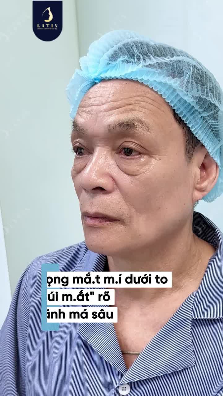 COMBO MIDFACE + MÍ DƯỚI GIÚP "PHONG ĐỘ" GÕ CỬA LẦN HAI