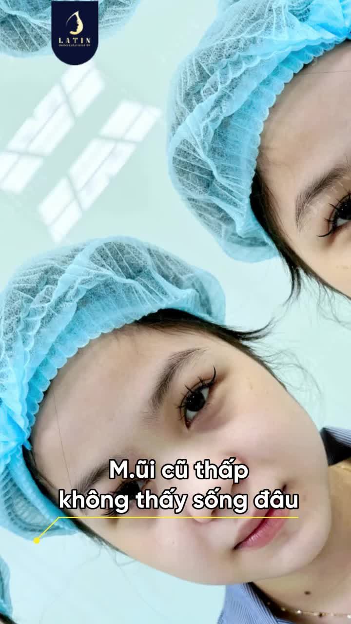 NÂNG MŨI ĐÃ GIÚP CÔ ẤY TÌM LẠI SỰ TỰ TIN RA SAO?