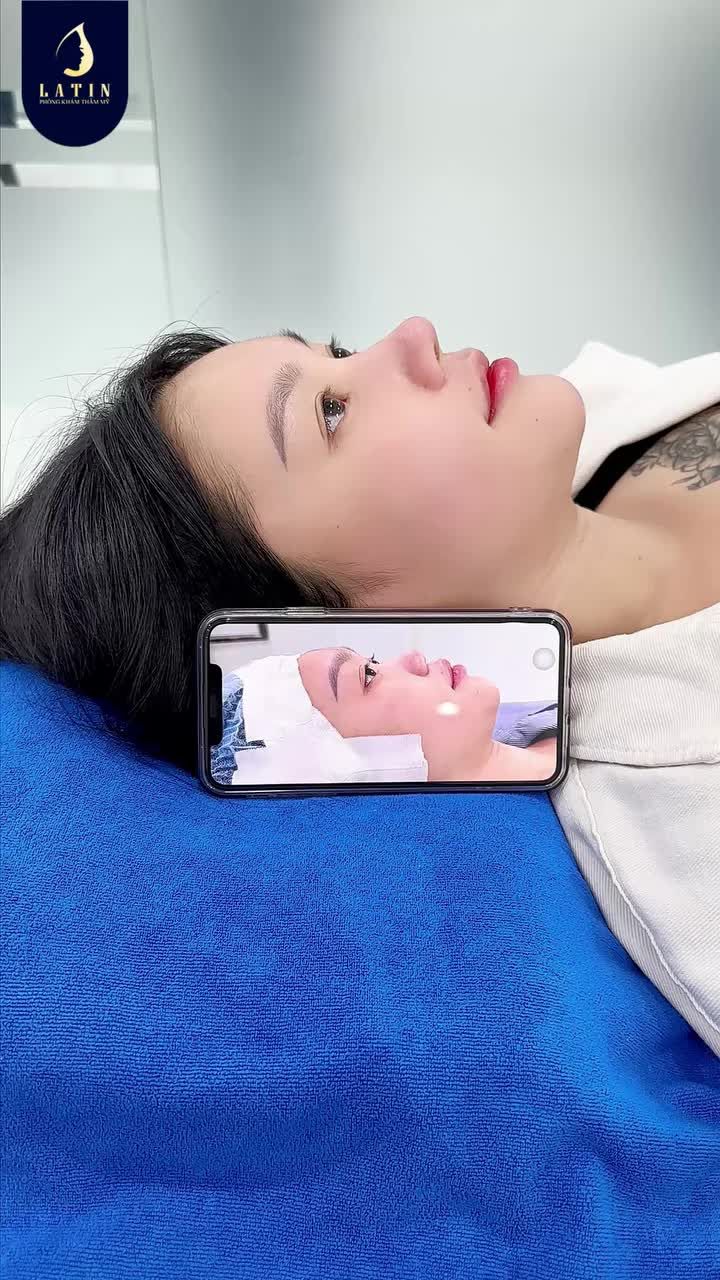 CHỈ SAU 10 NGÀY, DÁNG MŨI MỚI ĐÃ "LÊN FORM" RA SAO?