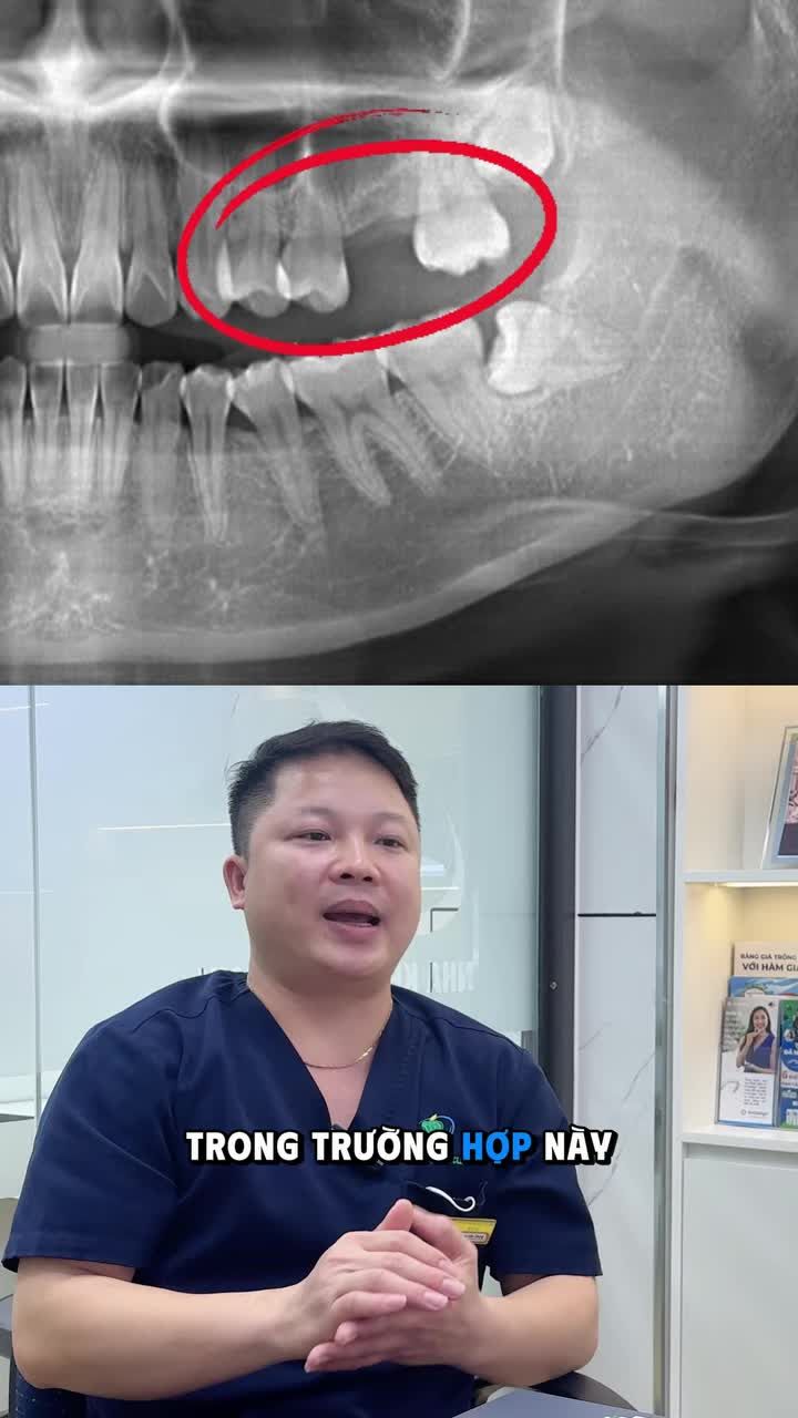 NÂNG XOANG KÍN TRONG TRỒNG RĂNG IMPLANT LÀ GÌ?