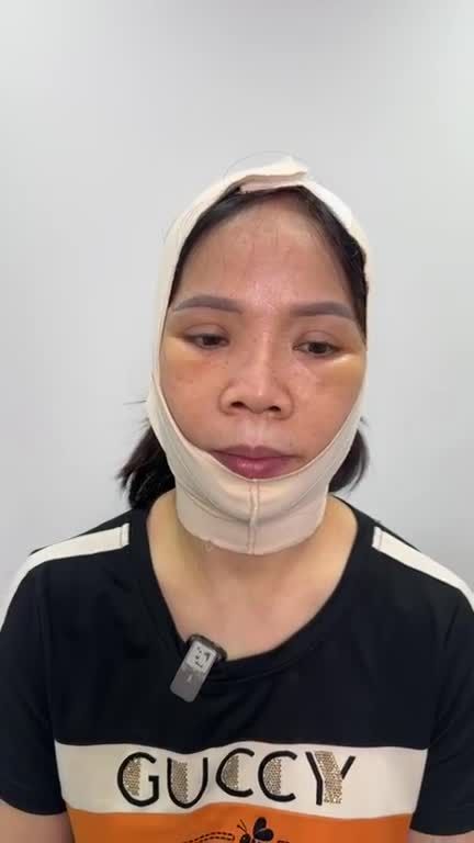 Muốn TRẺ 20 TUỔI có JW lo! Xem ngay kết quả CĂNG DA MẶT SMAS của Quý cô U60 sau 10 ngày