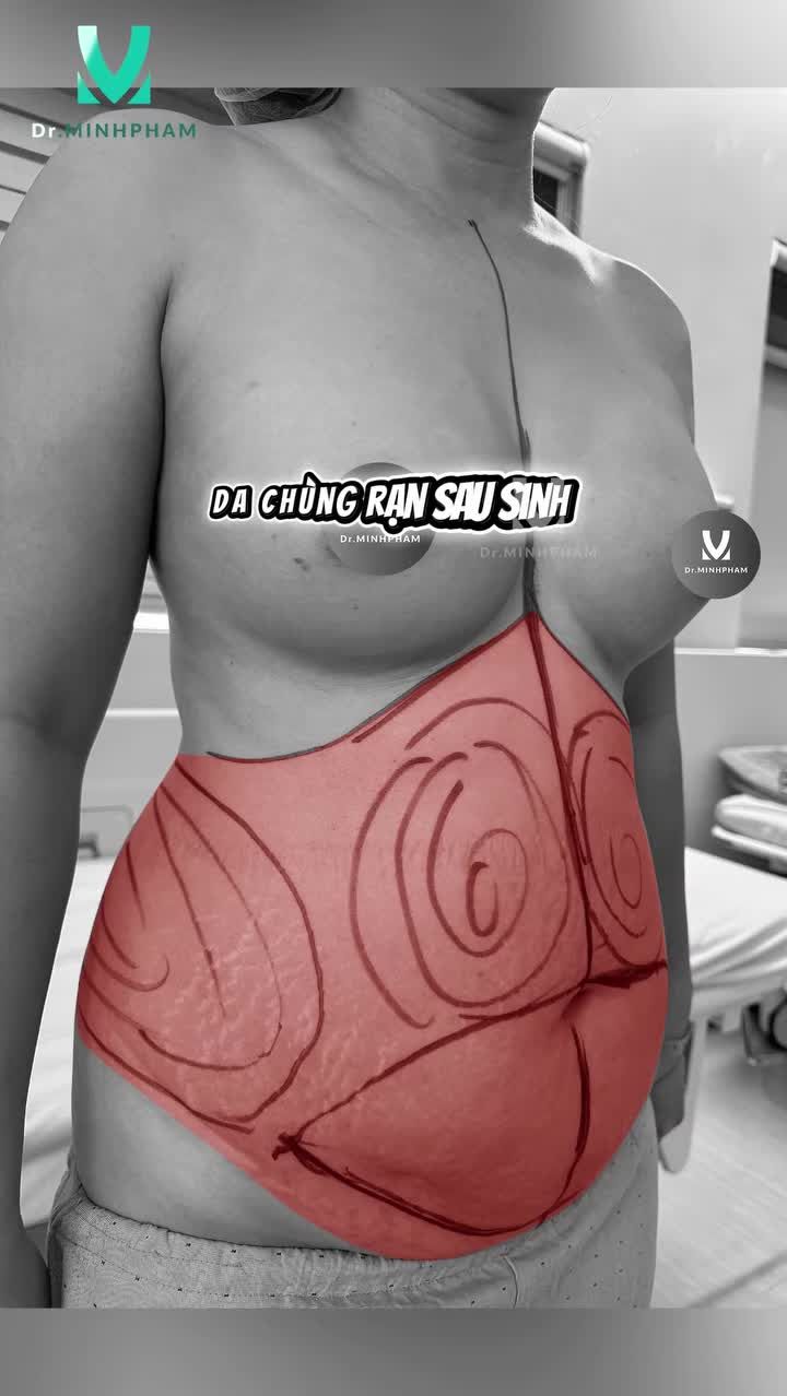 Sau sinh, nhiều mẹ bỉm gặp tình trạng mỡ bụng tích tụ, eo kém săn chắc dù đã ăn kiêng và tập luyện.