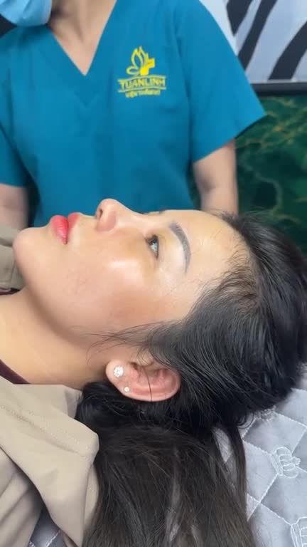 10 NGÀY SAU NÂNG MŨI CẤU TRÚC SURGIFORM – DÁNG MŨI VÀO FORM ĐẸP TỰ NHIÊN