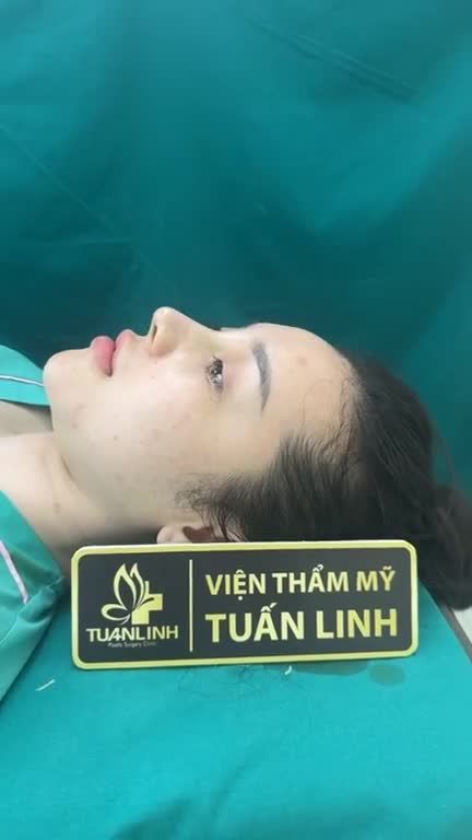 Mũi bọc sụn sau phẫu thuật