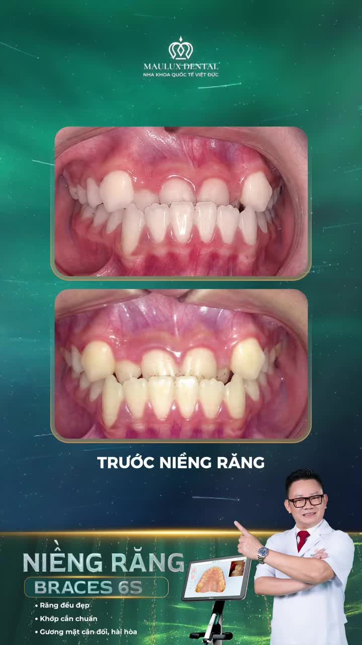Niềng răng giúp con thay đổi thế nào?