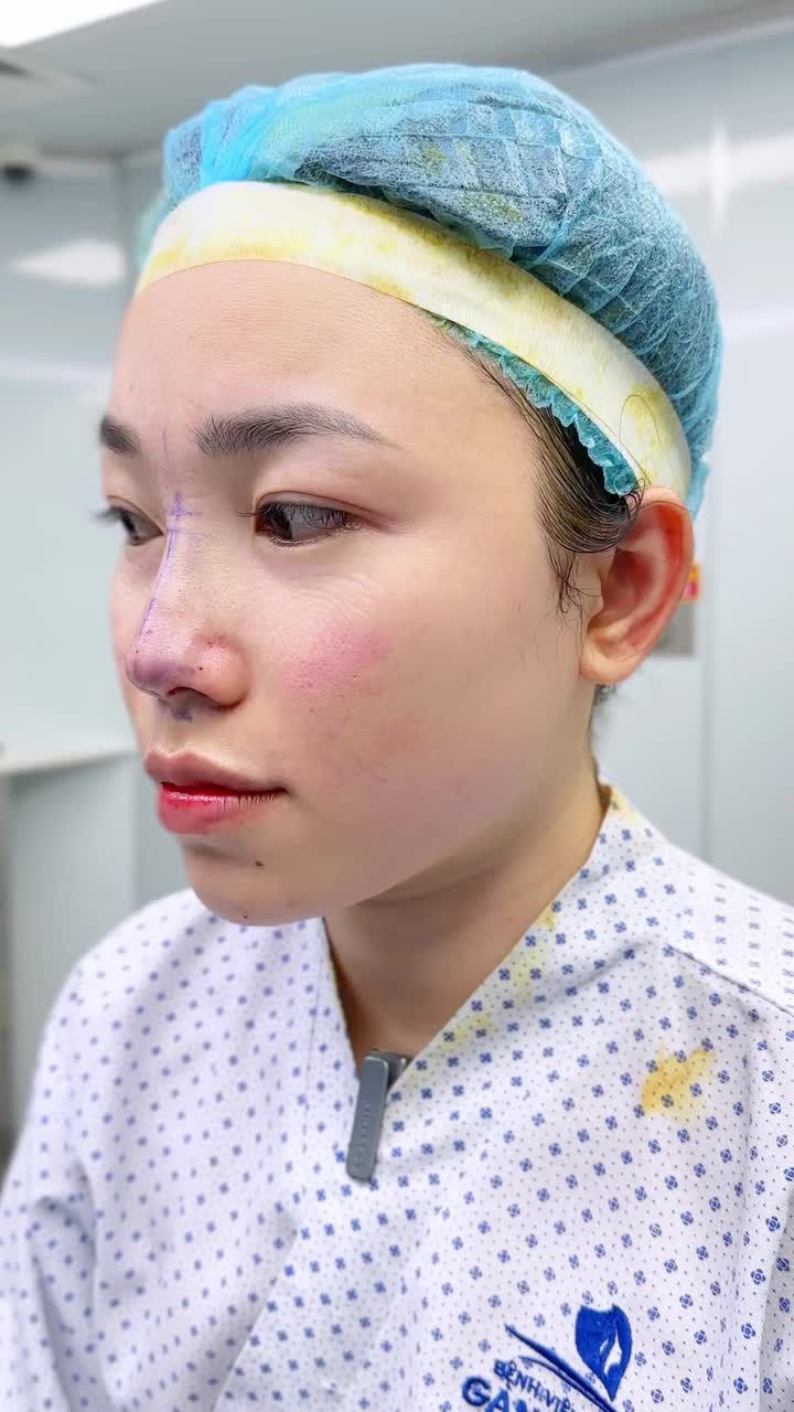 ĐẸP XUẤT SẮC SAU 60 PHÚT: DÁNG MŨI BỌC SỤN CÂN ĐỐI TỶ LỆ VÀNG VỚI DÁNG CẰM TIÊM FILLER!