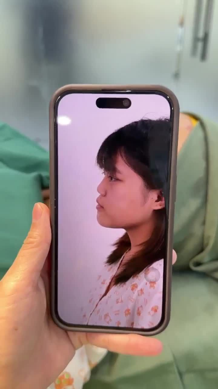 TRẢ KẾT QUẢ NÂNG MŨI CẤU TRÚC CHO BẠN TÂN SINH VIÊN 2K8