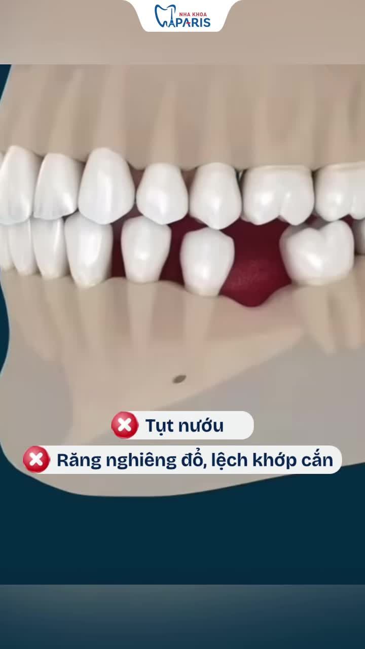 ĐỪNG CHỦ QUAN KHI MẤT CHỈ 1 CHIẾC RĂNG!