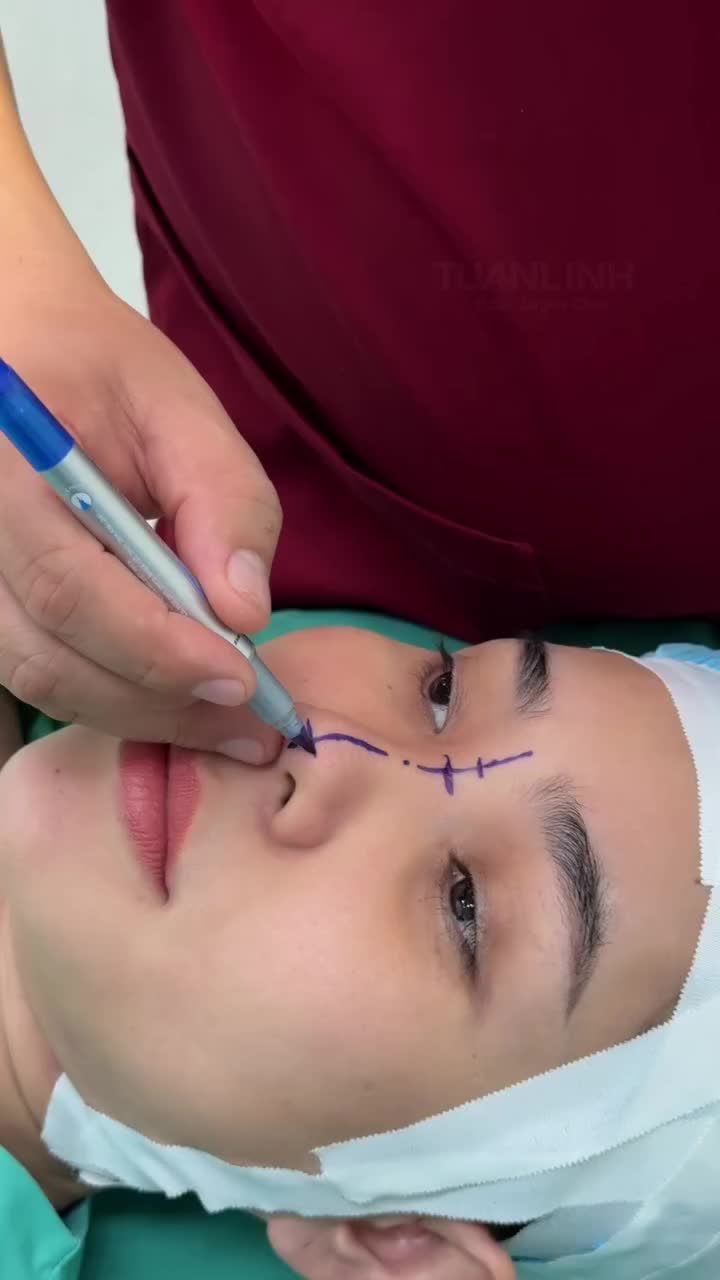 MŨI CẤU TRÚC THIẾT KẾ – ĐẸP CHUẨN TỶ LỆ VÀNG NGAY SAU PHẪU THUẬT