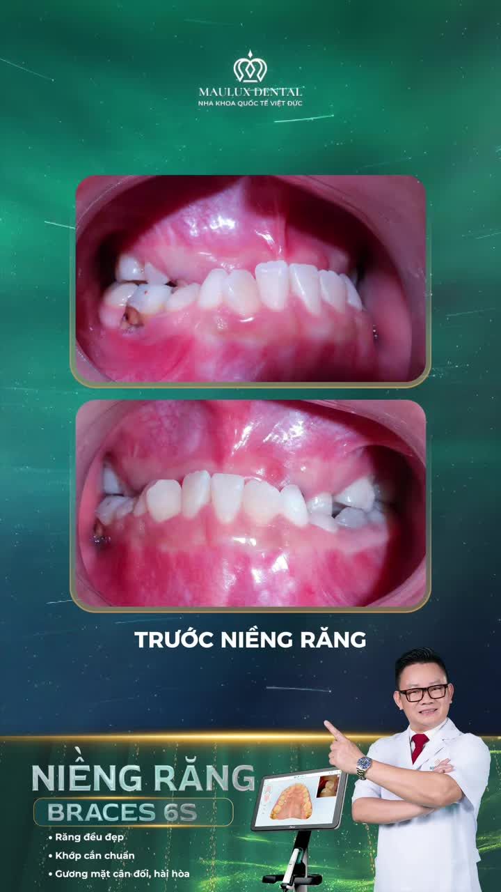 Khớp cắn ngược niềng răng có hết không?